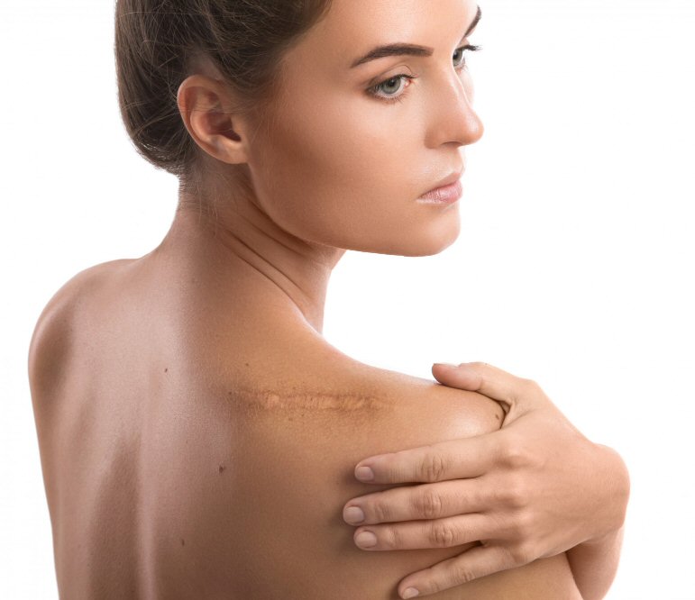 A Niort, le laser stimule la procduction de collagène dans les couches profondes de la peau